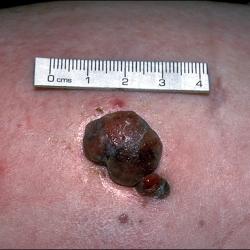 Example of skinCancerAndMelanomas
